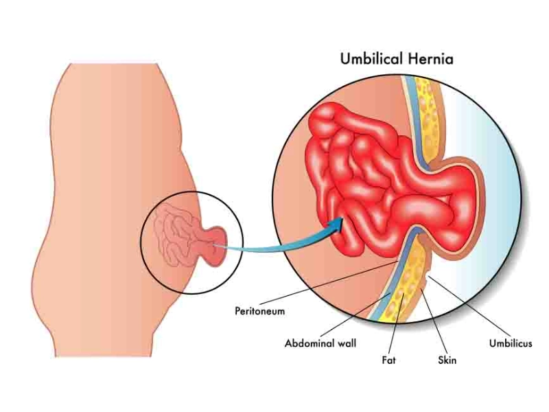 hernia