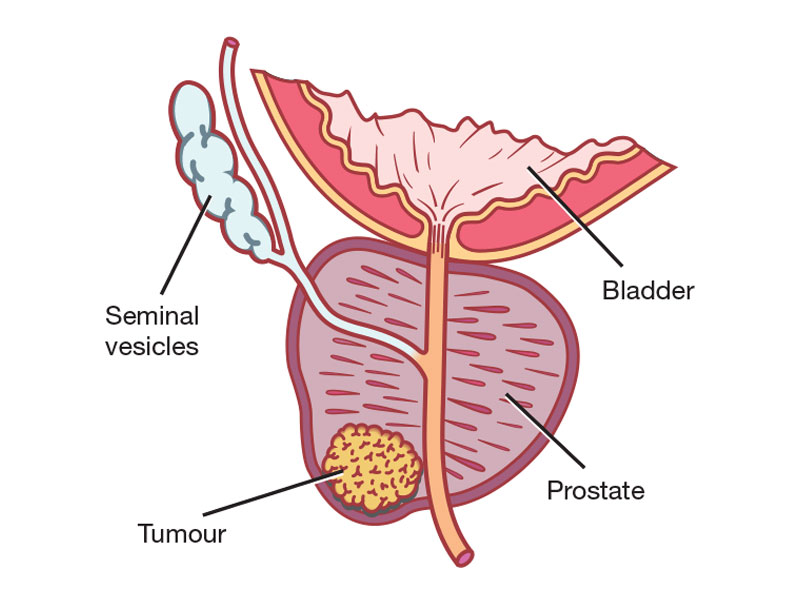 prostate