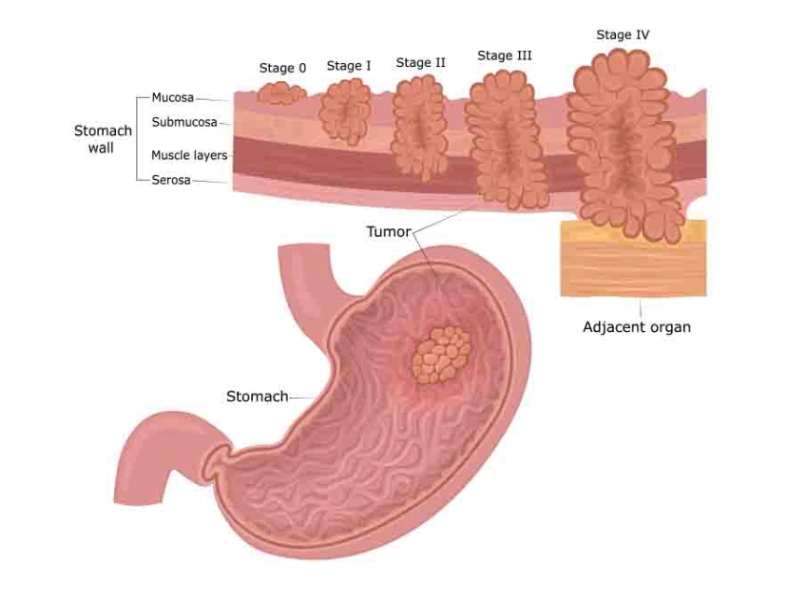 stomach_cancer